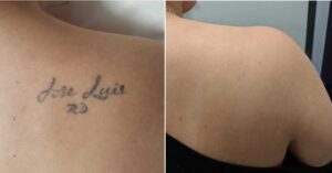 New and Improved: The Best Tattoo Removal in Sydney